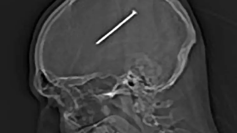 Zabio si čavao u glavu, a da to nije ni primijetio!