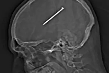 Zabio si čavao u glavu, a da to nije ni primijetio!