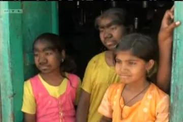 Zbog opake bolesti izgledaju kao vukodlaci!