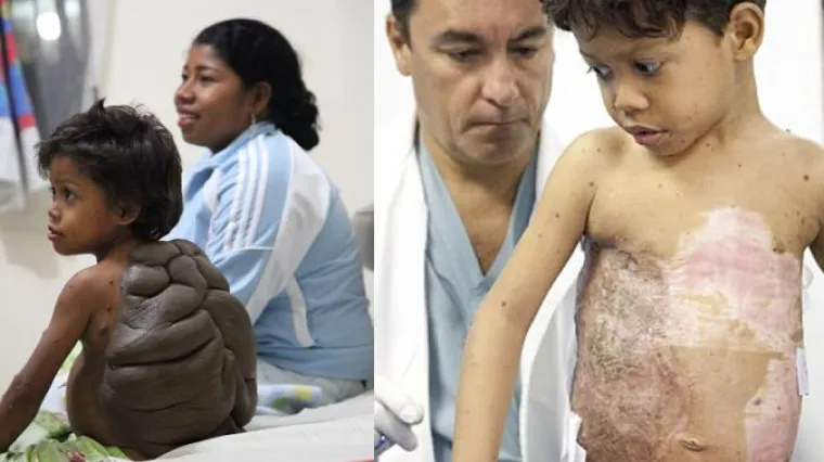 'Dječak kornjača' napokon može normalno živjeti