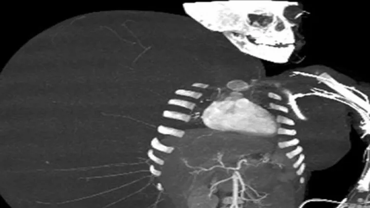 Dječačić imao tumor teži od njega samoga