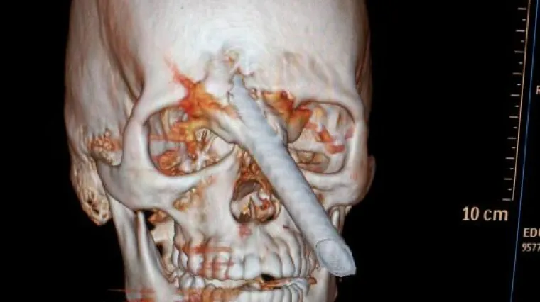 &Scaron;ipka od dva metra mu probila lubanju, ostao živ