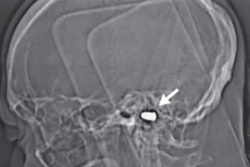 Izliječio mu štucavicu metkom u glavu