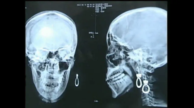 Živjela s iglom u mozgu dugih 27 godina!