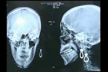 Živjela s iglom u mozgu dugih 27 godina!