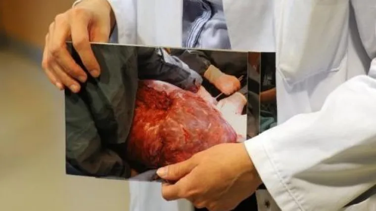Iz tijela pacijentice izvadili tumor težak 28 kila!