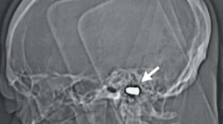 Golmana Du&scaron;ka ni metak u glavi nije mogao zaustaviti
