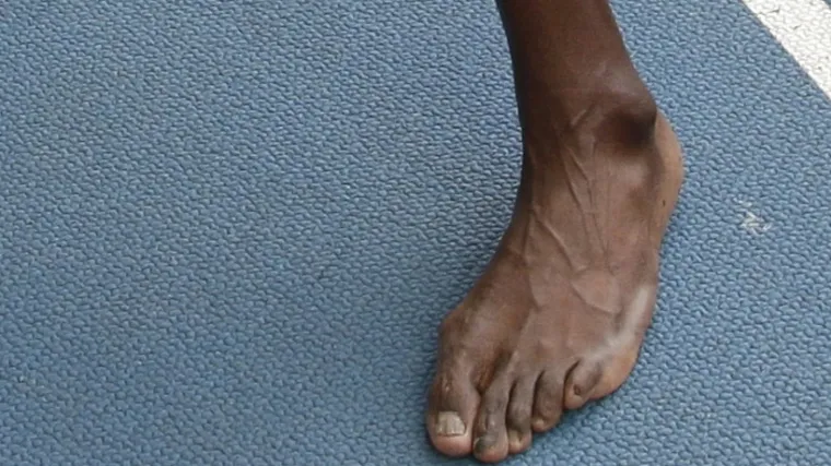 Usain Bolt očajnički treba pedikuru!