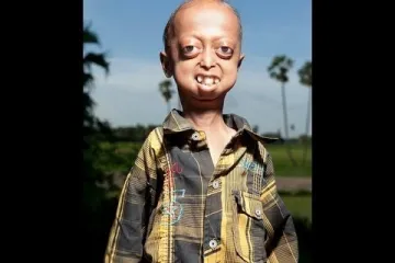 Ovaj 14-godišnji dječak ima tijelo starca od 110 godina