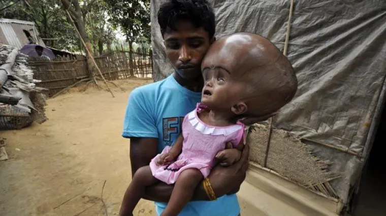 Djevojčica s vi&scaron;kom tekućine u mozgu sada živi normalno