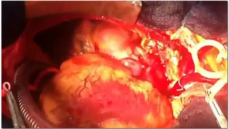 Prva transplatacija srca u Srbiji nakon 14 godina stanke