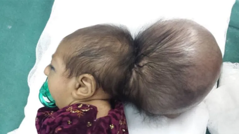 Tromjesečnoj djevojčici uspje&scaron;no odstranili dodatnu glavu!