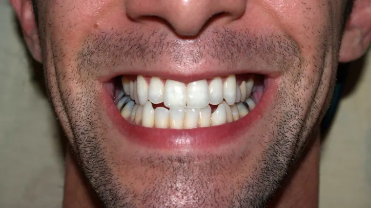 Sporta&scaron;i imaju zapanjujuće lo&scaron;e zube