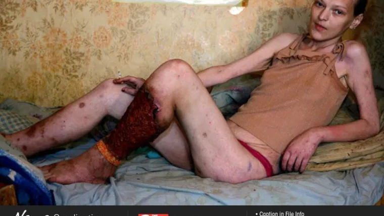 Krokodil, nova vrsta droge od koje se raspada tkivo