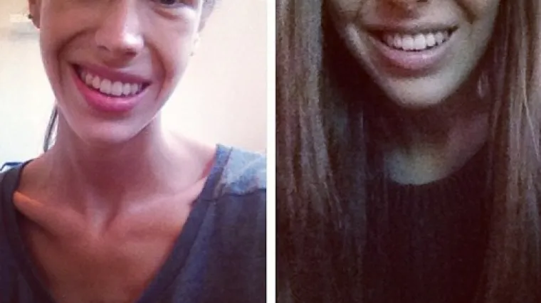 Svoju borbu protiv anoreksije podijelila na Instagramu