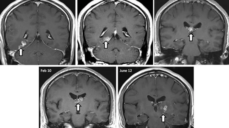 Crv živio u mozgu Britanca i zadavao mu glavobolje!