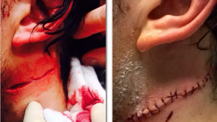 Hokeja&scaron;u protivnik klizaljkom zarezao vrat i poslao ga u bolnicu