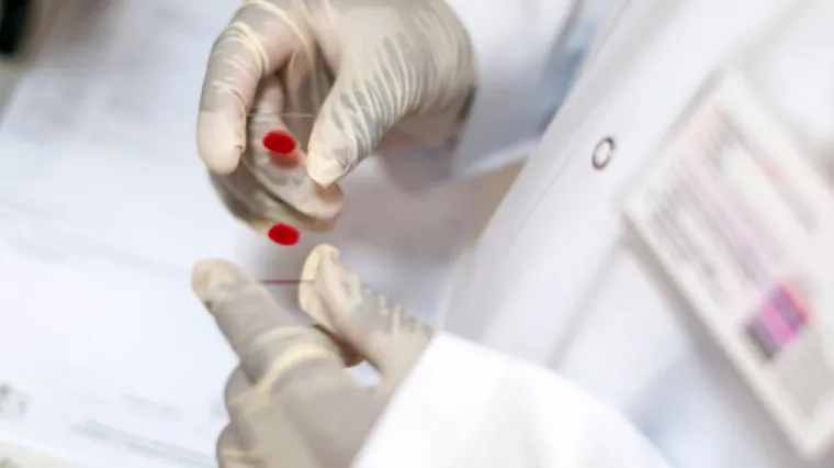 Otkriven najagresivniji oblik smrtonosnog virusa HIV-a!