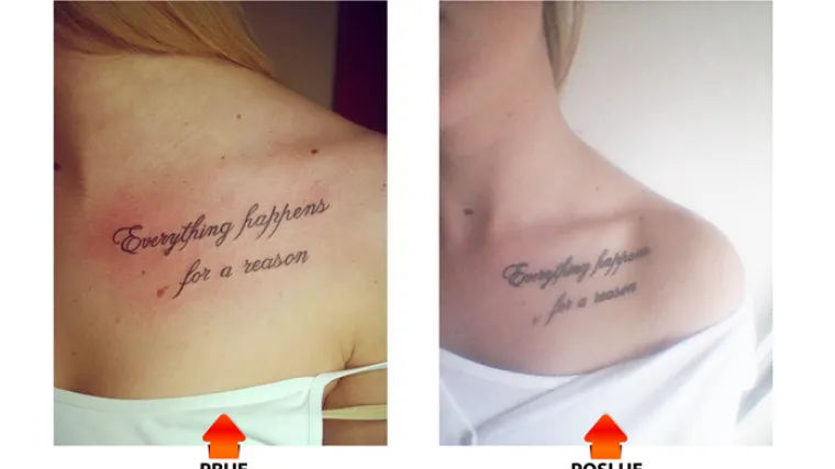 Njega koja vam je potrebna nakon tetoviranja