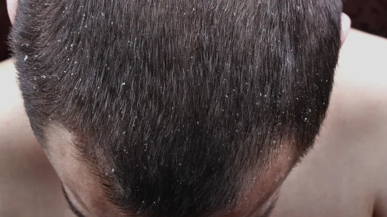 Prirodni lijek protiv peruti!