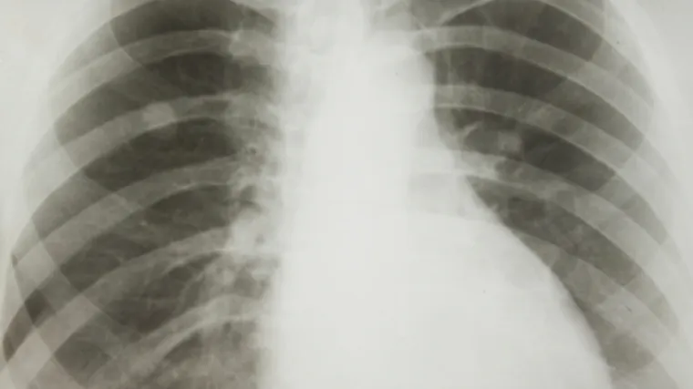 Dobre vijesti iz SAD-a: lijek AstraZenece odobren kao lijek prvog izbora za rak pluća!