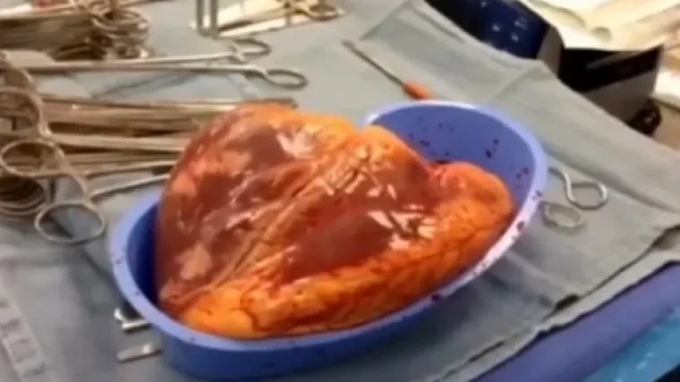 Nastavilo kucati 25 minuta nakon &scaron;to je izvađeno iz tijela donora