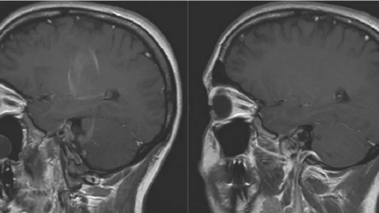 Evo kako čak i umjereni stres mijenja mozak i na &scaron;to vas tjera