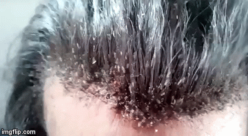 U kosi mu se namnožile u&scaron;i, pogledajte samo ako imate dobar želudac