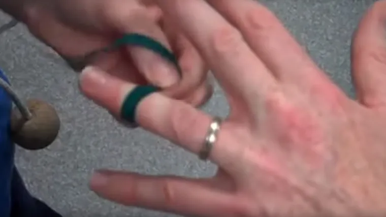 Nevjerojatno jednostavan i učinkovit način skidanja prstena