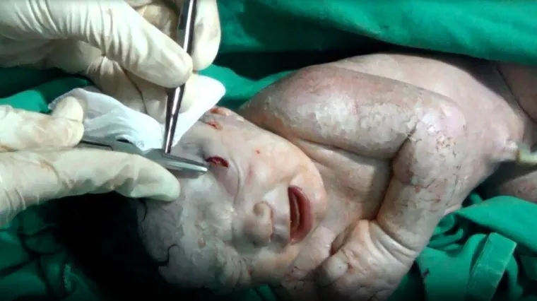 Hitni carski rez nad sirijskom trudnicom jer se njenoj nerođenoj bebi u glavu zabio &scaron;rapnel!