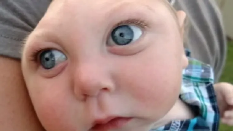 Svu su mislili da će umrijeti jer nema lubanju, a on tepa i uči hodati!