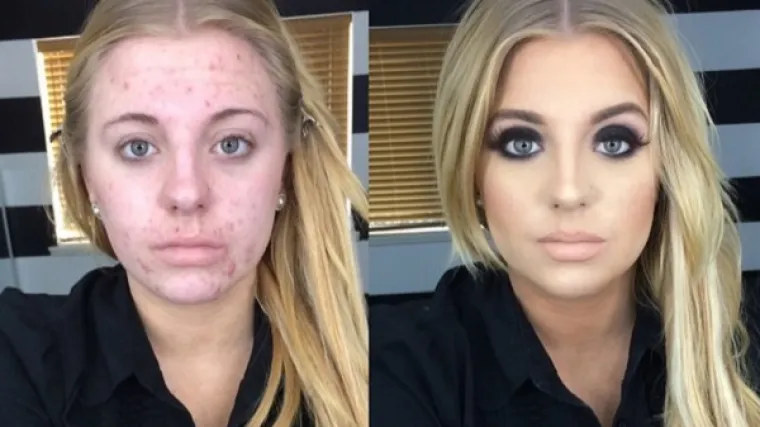 Djevojka koja pati od akni uzvratila udarac zlostavljačima