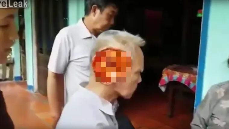 Virus mu pojeo lice, doktori potpuno zbunjeni