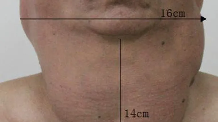 Alkoholičar koji je 30 godina svaki dan pio po litru žestica danas izgleda ovako