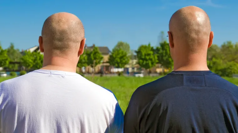 Pronađen lijek za ćelavost