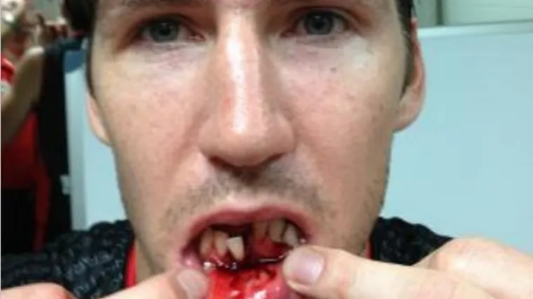 Pogledajte kako je Australac ostao bez tri zuba