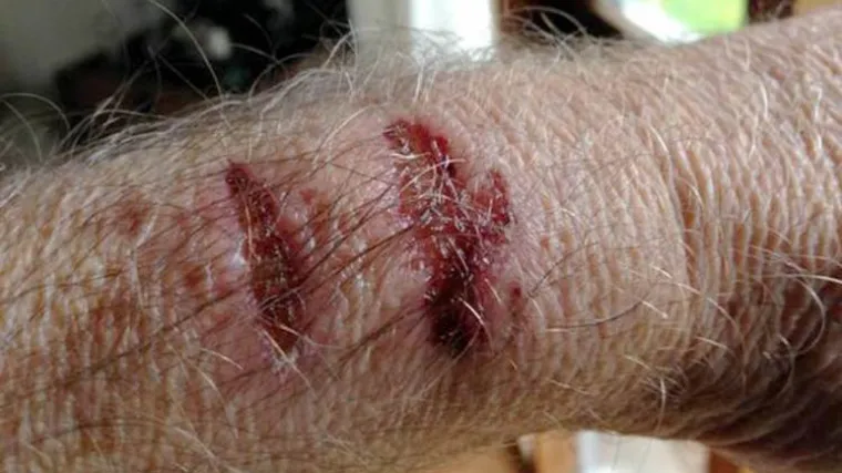 Apple Watch mi je na ruci ostavio trajne ožiljke od opeklina