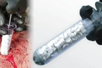 Ova sprava zatvara prostrijelne rane za manje od minute
