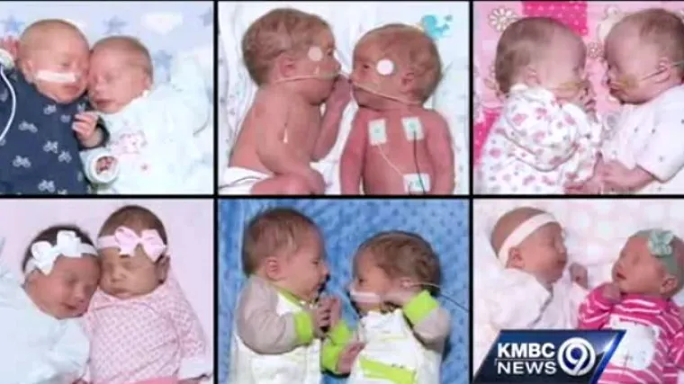 U Kanzasu u istoj bolnici istovremeno rođeno 6 parova blizanaca