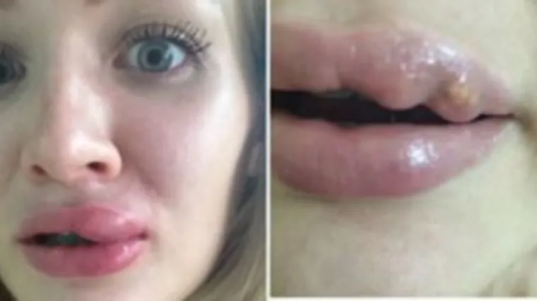 Povećala usne, pa joj poplavile i pojavile se bolne izrasline