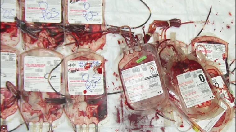 Zarazili 350 pacijenata HIV-om i hepatitisom