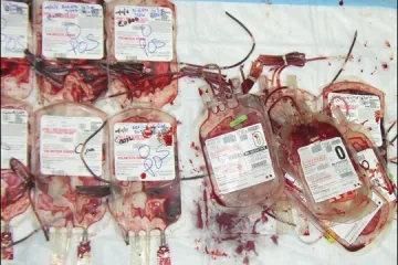 Zarazili 350 pacijenata HIV-om i hepatitisom