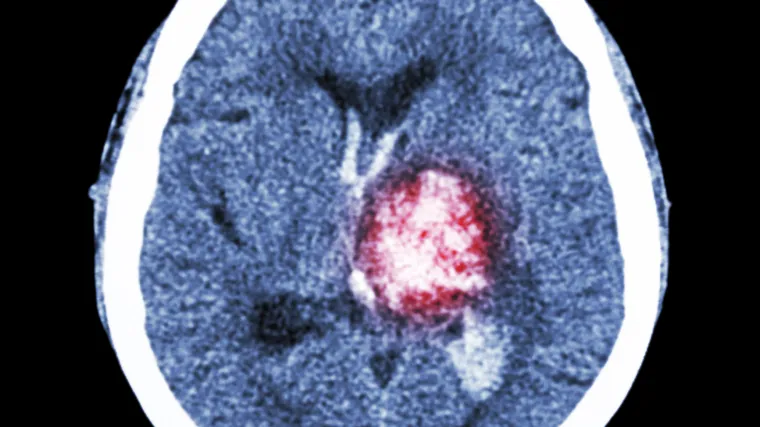 Izazivanje drugog moždanog udara pobolj&scaron;ava oporavak od prvog