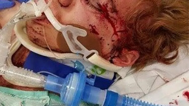 Zbog web-izazova zamalo poginuo, ali više nikada neće biti isti