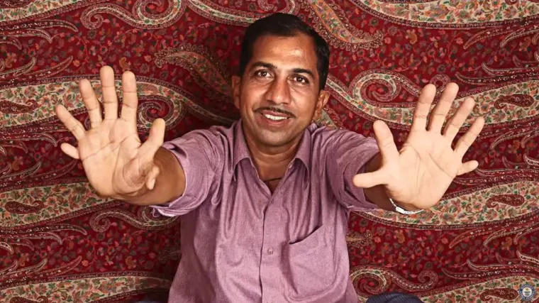 Čovjek s 28 prstiju smatra se sretnikom