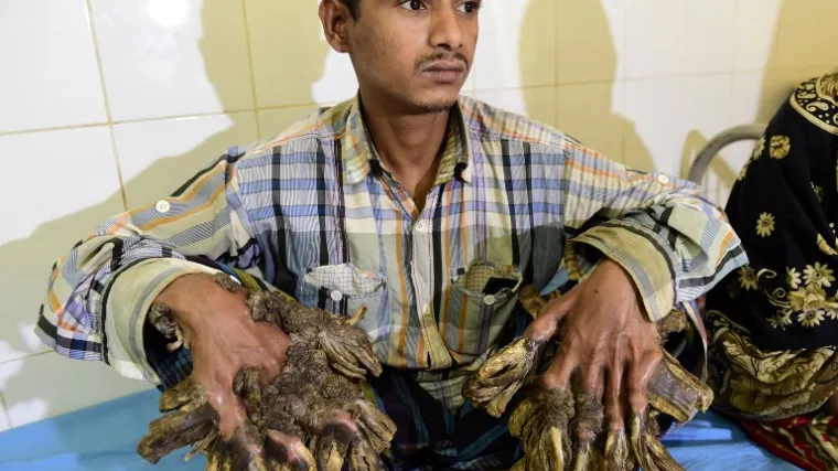 Napokon operacija za 'čovjeka-drvo' iz Banglade&scaron;a