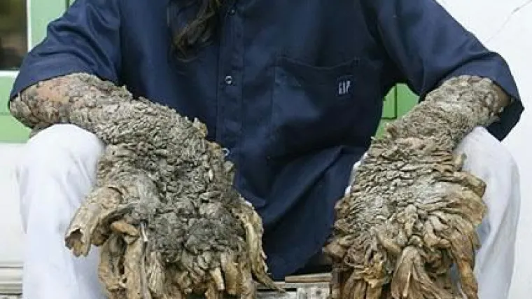 Nakon duge borbe s rijetkom bolesti preminuo je 'Čovjek-drvo'