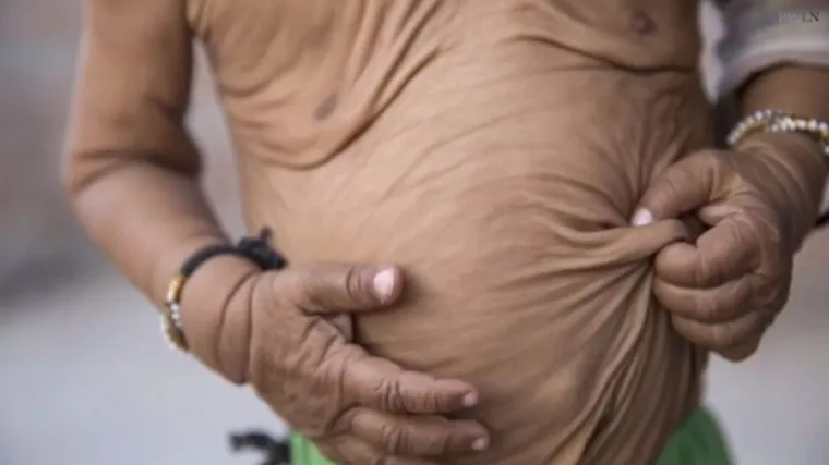 Brat i sestra rođeni s progerijom, a &scaron;anse za to su 1 prema 8 milijuna!