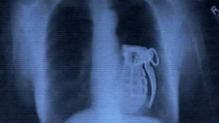 Najčudnije stvari otkrivene na rendgenu