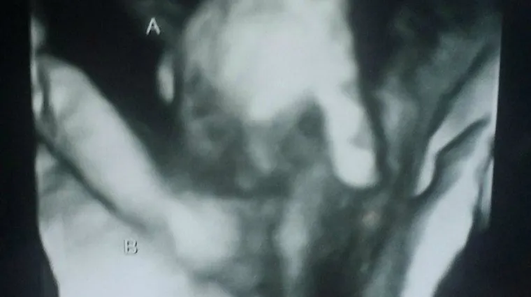 Utje&scaron;na fotografija s ultrazvuka: dječak koji umire drži svoju sestru blizanku za ruku!